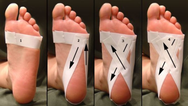 sports tape for plantar fasciitis