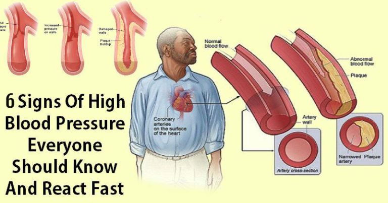 6-signs-that-could-mean-you-have-high-blood-pressure