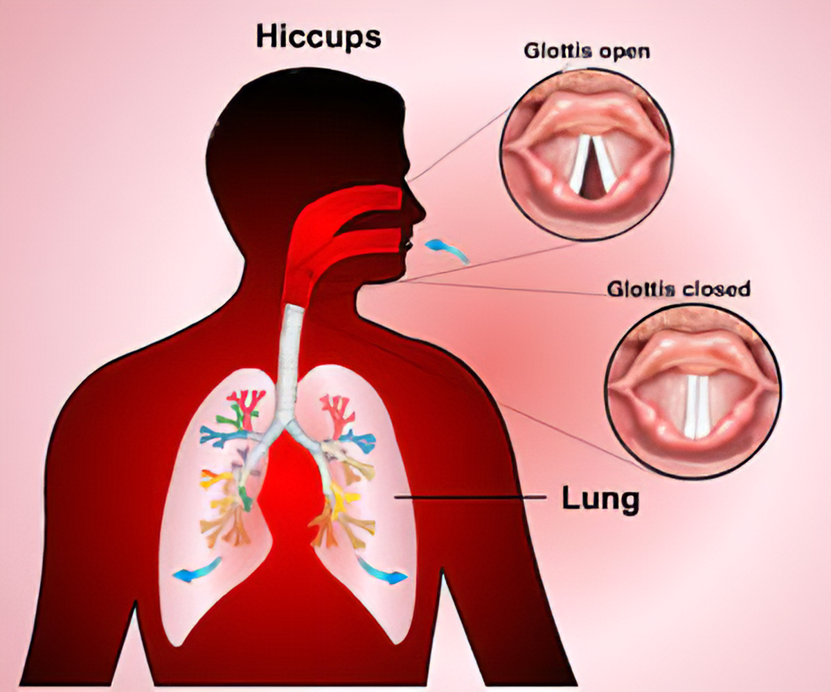 Hiccups 