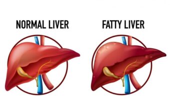 Non Alcoholic Fatty Liver Disease Treatment